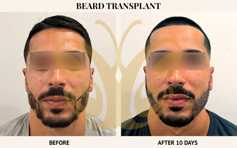 Before and after FUE Hair Transplant at Cocoon Medical Spa Bali