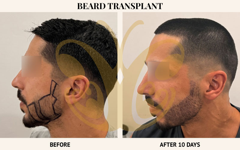 Before and after Hair transplant results in Bali