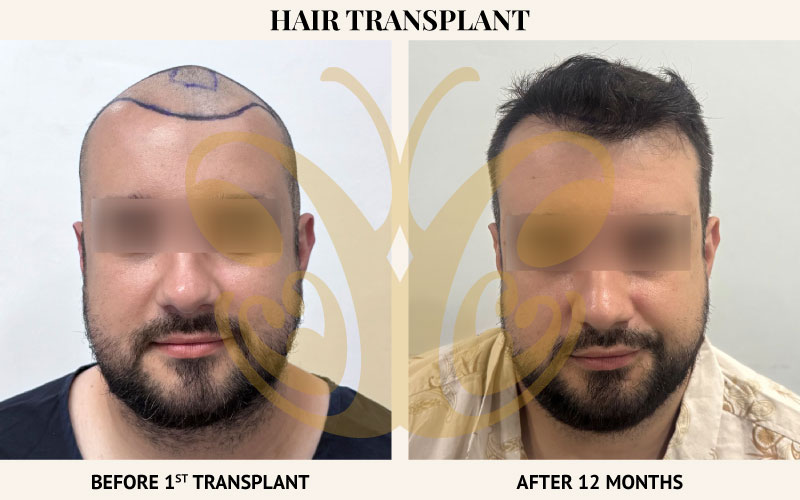 First round hair transplant 12 months result at Cocoon Medical Spa