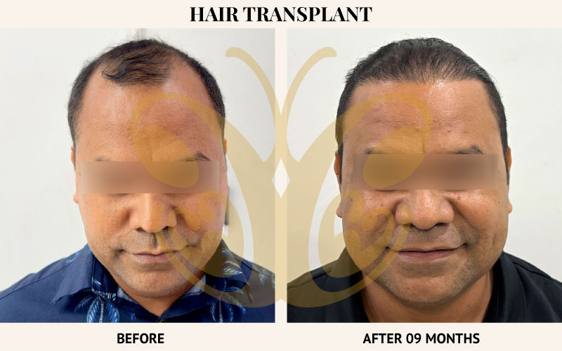 Forehead FUE Hair Transplant results at Cocoon Medical Spa