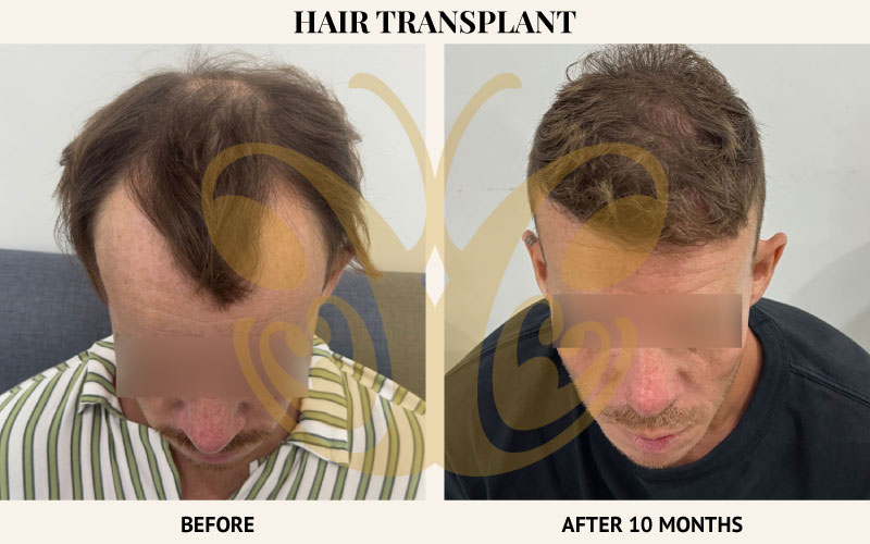 Hair Transplant results at Cocoon Medical Spa