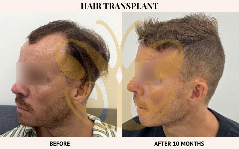 Hair Transplant in Legian