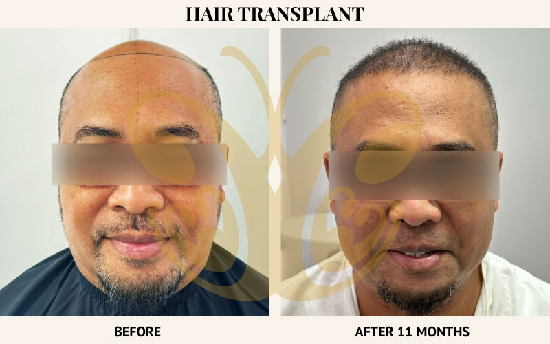 Before and after FUE Hair Transplant at Cocoon Medical Spa Bali