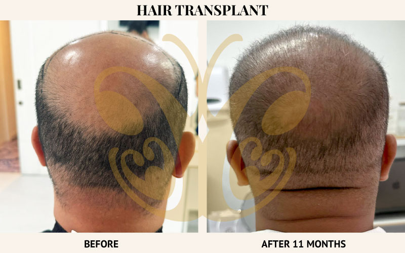 Before and after Hair transplant results in Bali