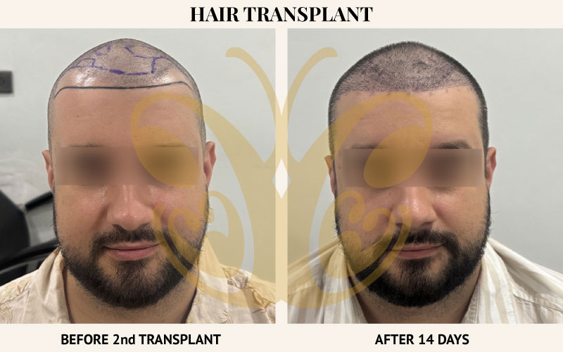 Second round hair transplant 14 days result in Legian