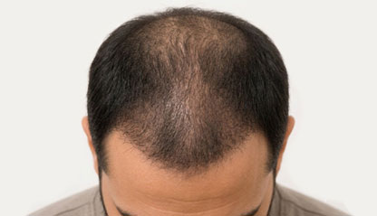 Image from a male head with a thin crown shown