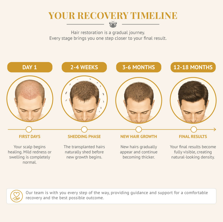 Illustration Fue Hair transplant recovery timeline
