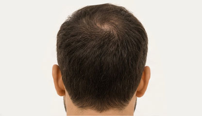 Image from a male head backside.