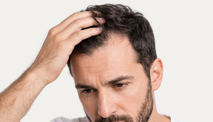 image of a men for hairline restoration.