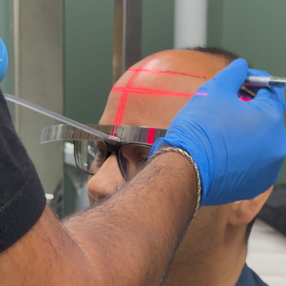 Mapping out hair transplant area